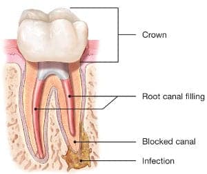 endodontic-retreatment-root-canal-300x253