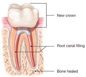 endodontic-retreatment-root-canal-crown-150x134@2x