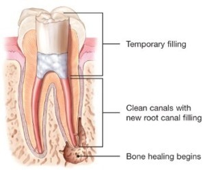 endodontic-retreatment-root-canal-temporary-150x124@2x