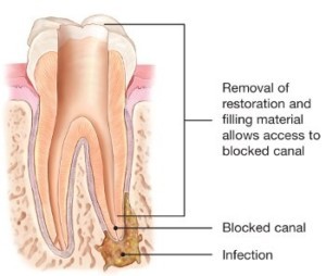 endodontic-retreatment-root-canals-150x127@2x