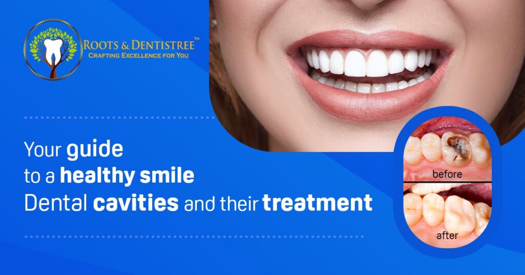 Your guide to a healthy smile: Dental cavities and their treatment