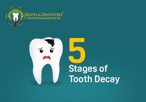 5 Stages of Tooth Decay
