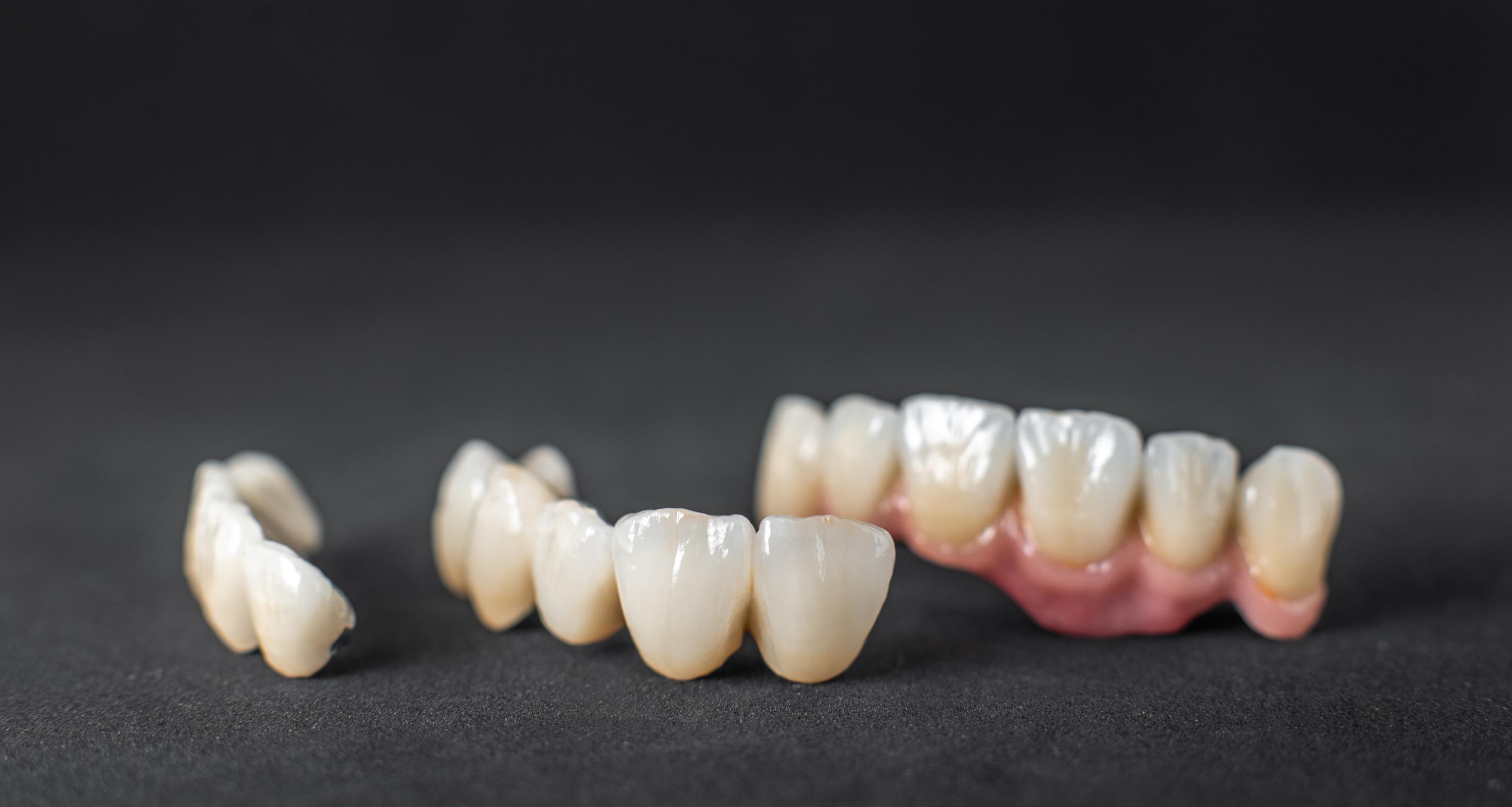 Close-up on dental crowns on the black background. Concept of prosthetics and implantation in dentistry