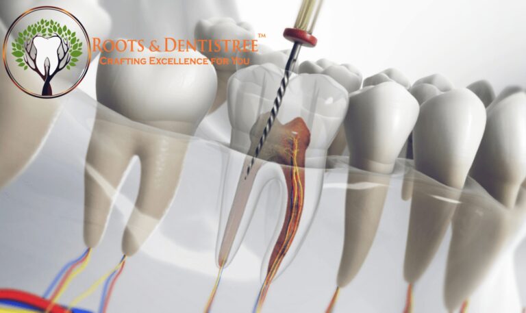 What to know About Root Canal Treatment?