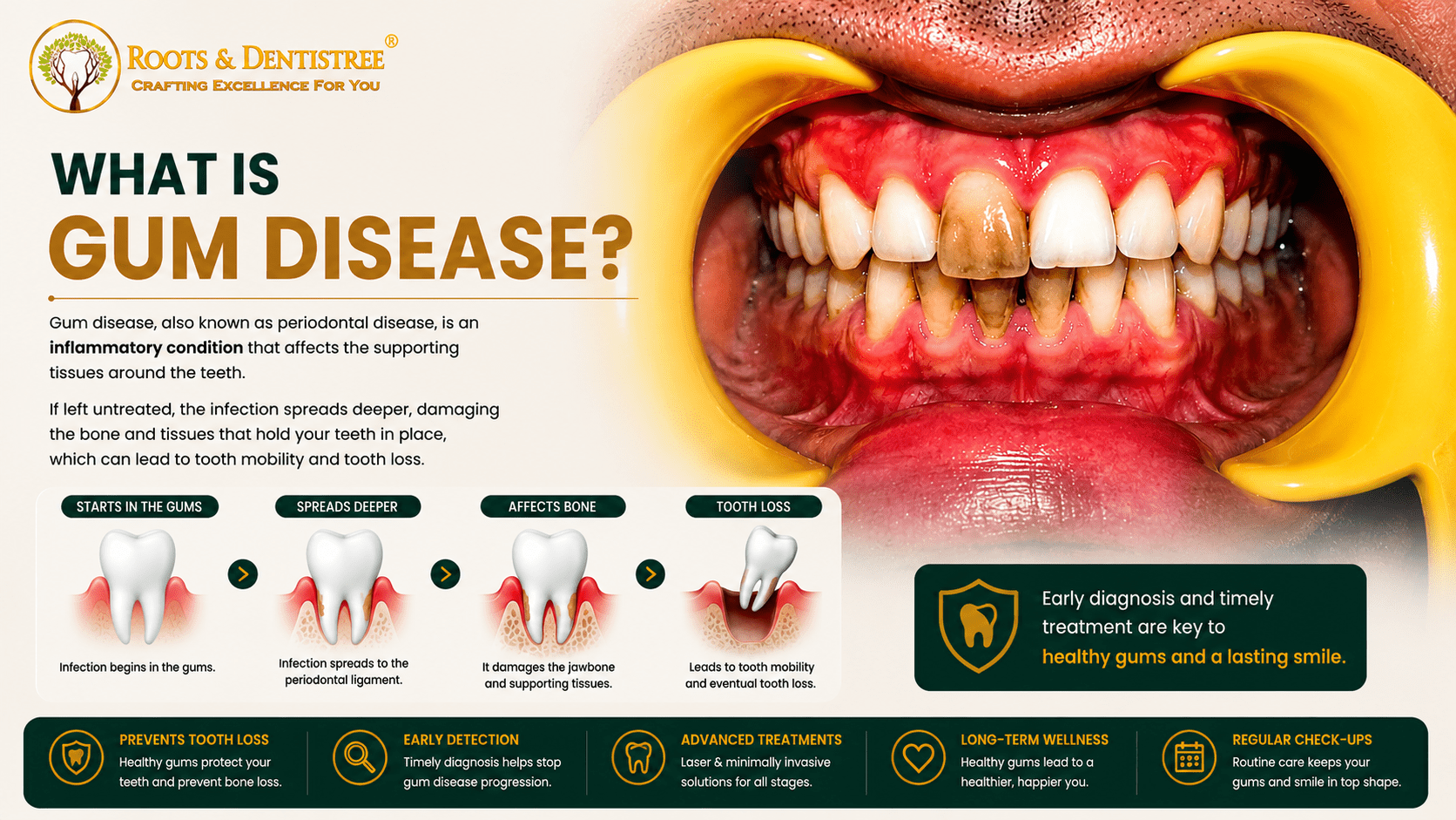 WHAT IS GUM DISEASE@ ROOTS & DENTISTREE