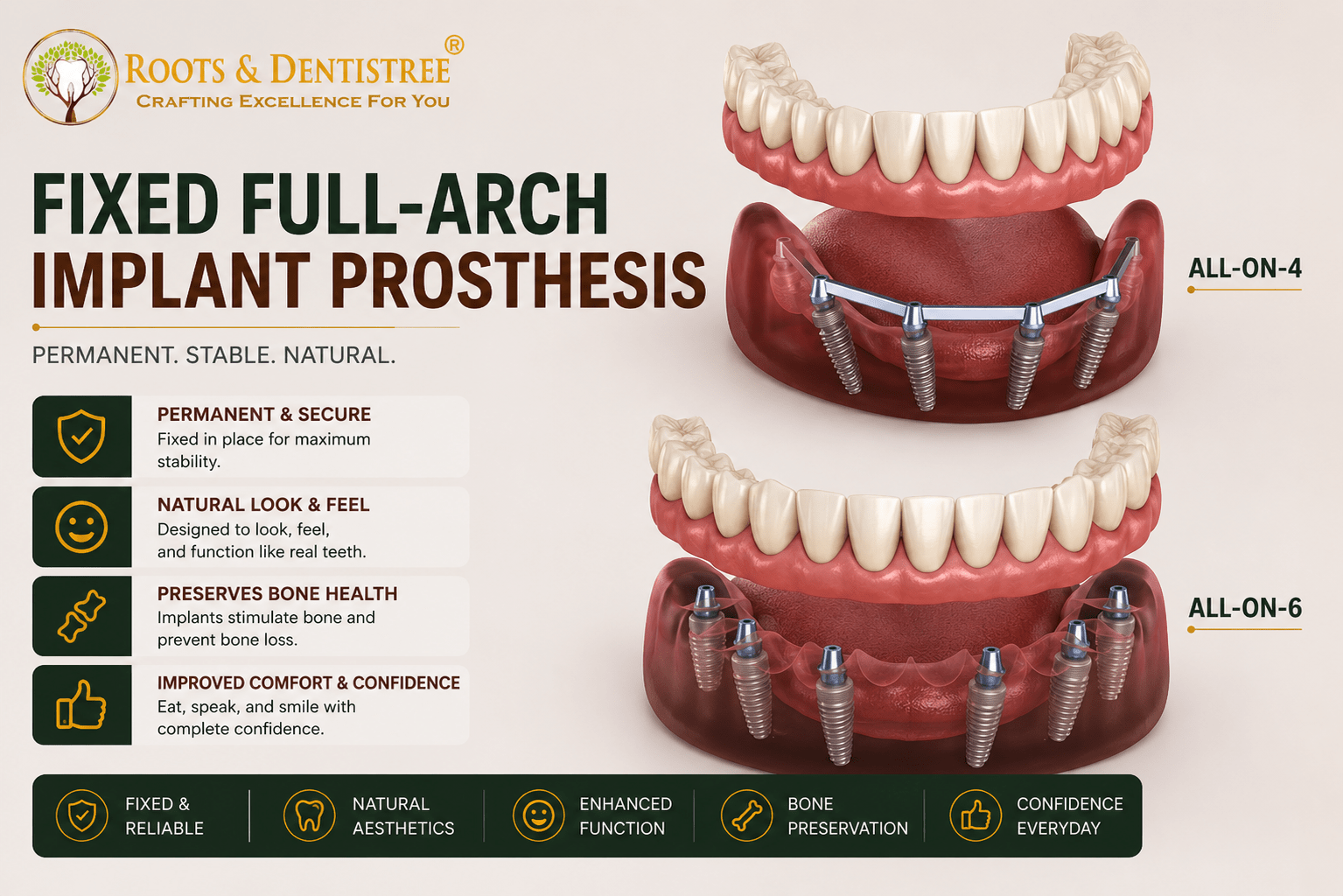 FIXED FULL ARCH IMPLANT PROSTHESIS@ ROOTS & DENTISTREE