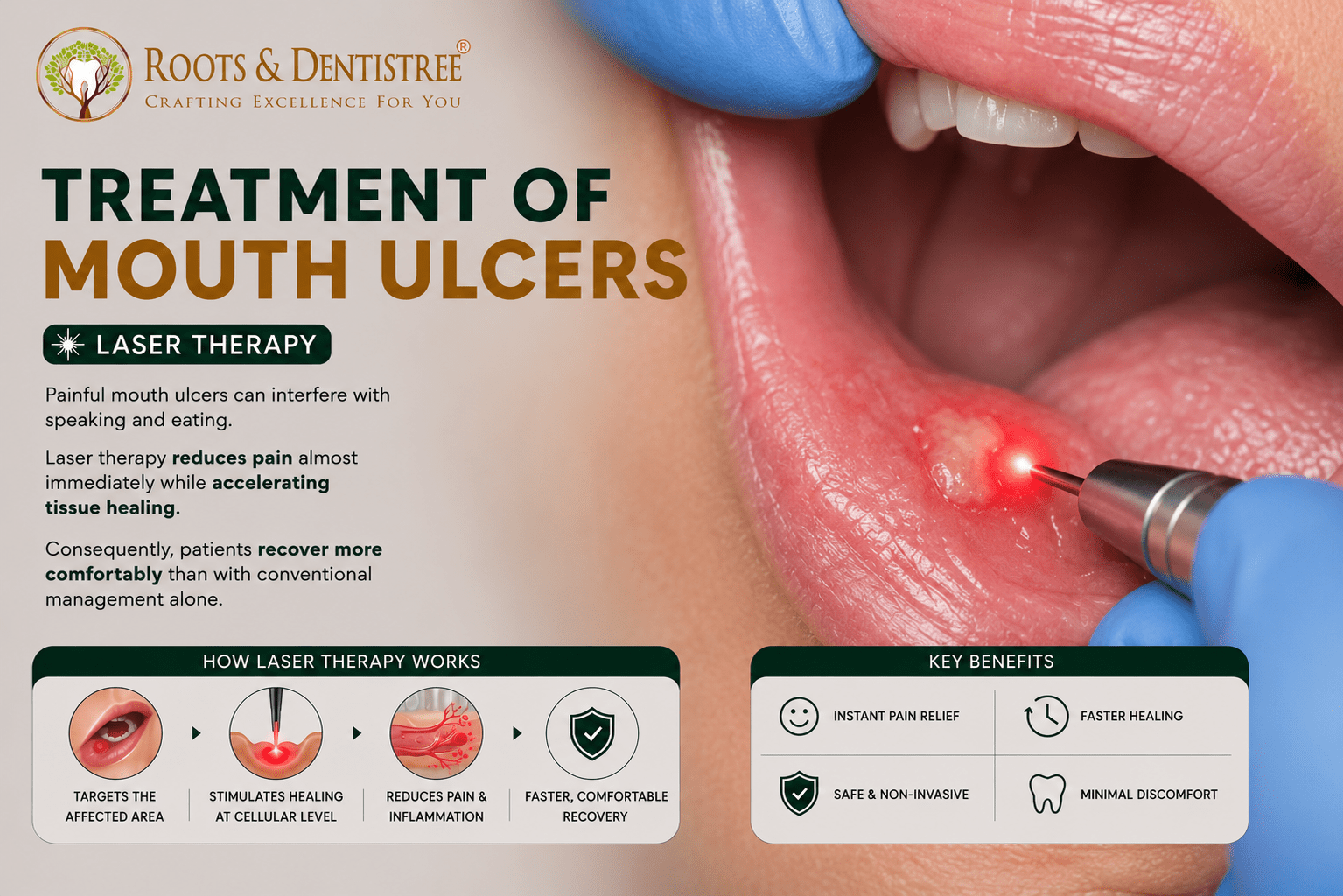 LASER MOUTH ULCER TREATMENT@ ROOTS & DENTISTREE