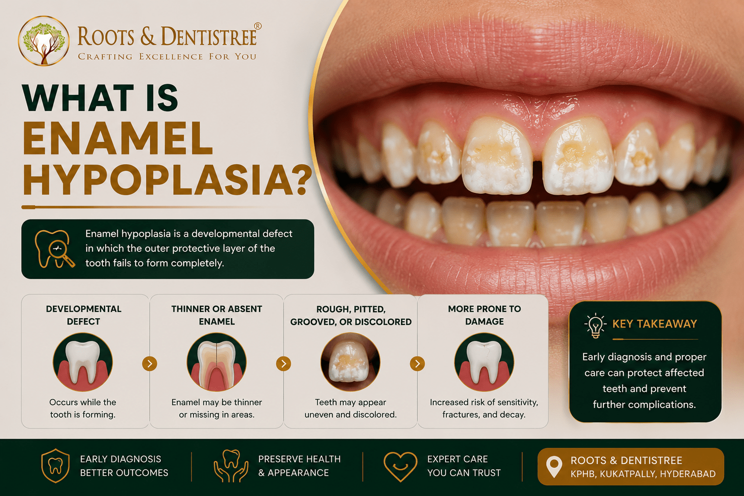 WHAT IS ENAMEL HYPOPLASIA @ROOTS & DENTISTREE