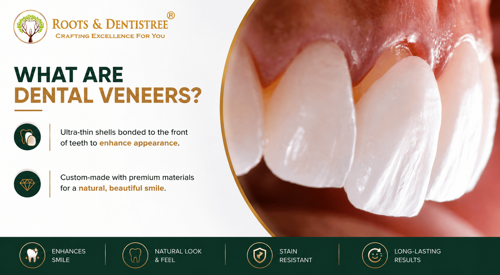 WHAT ARE DENTAL VENEERS@ ROOTS & DENTISTREE