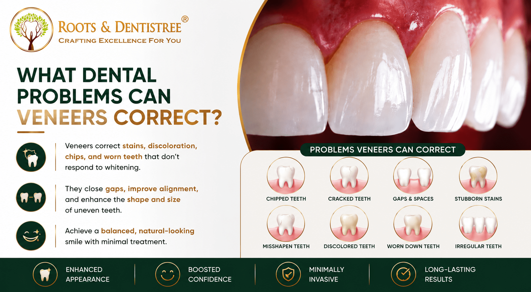 WHAT DENTAL PROBLEMS VENEERS CAN CORRECT@ ROOTS & DENTISTREE