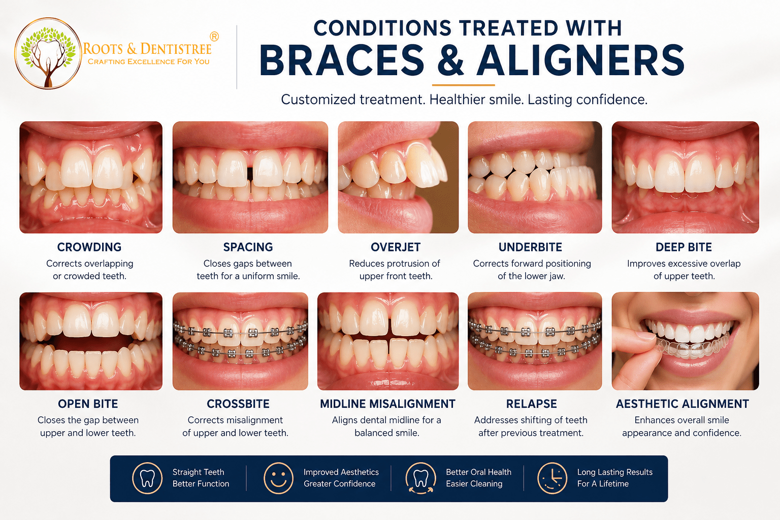 Malocclusions Treated Using BRACES & ALIGNERS @ ROOTS & DENTISTREE
