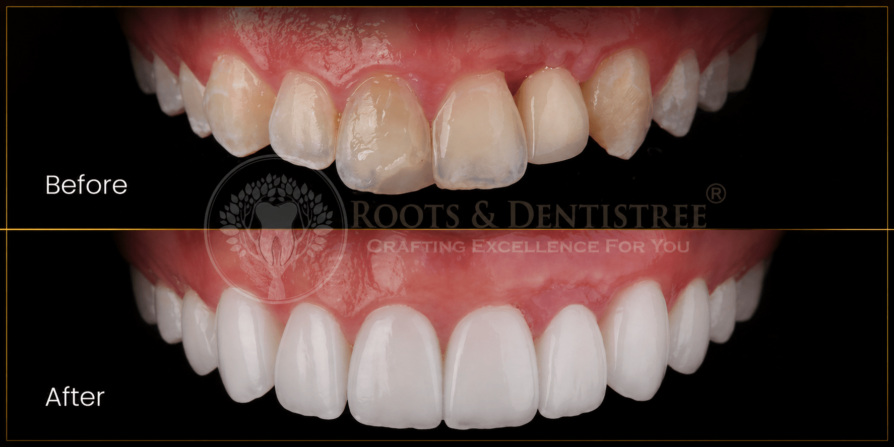 Cosmetic Dentistry Smile with Full Contour E-Max Crowns @ ROOTS & DENTISTREE