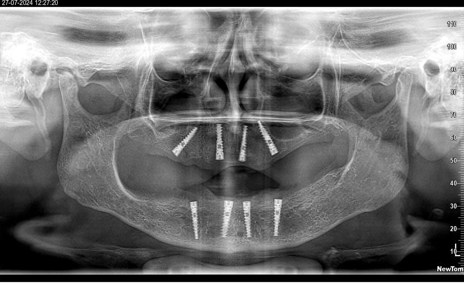 Panoramic dental X-ray showing multiple dental implants in the lower jaw and surrounding bone structures