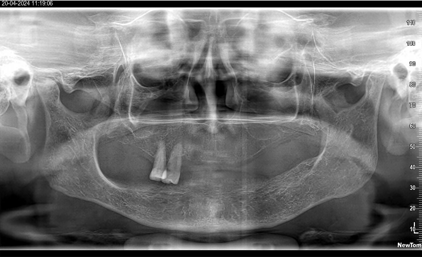 Advanced Dental Implant case @ rOOTS & DENTISTREE