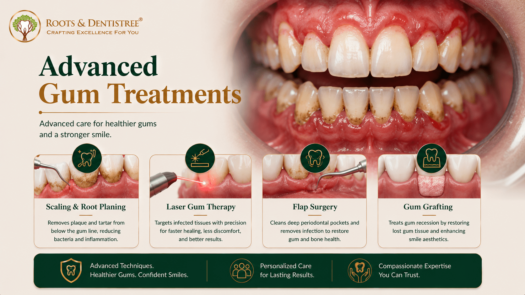 ADVANCED GUM TREATMENTS AVAILABLE @ ROOTS & DENTISTREE
