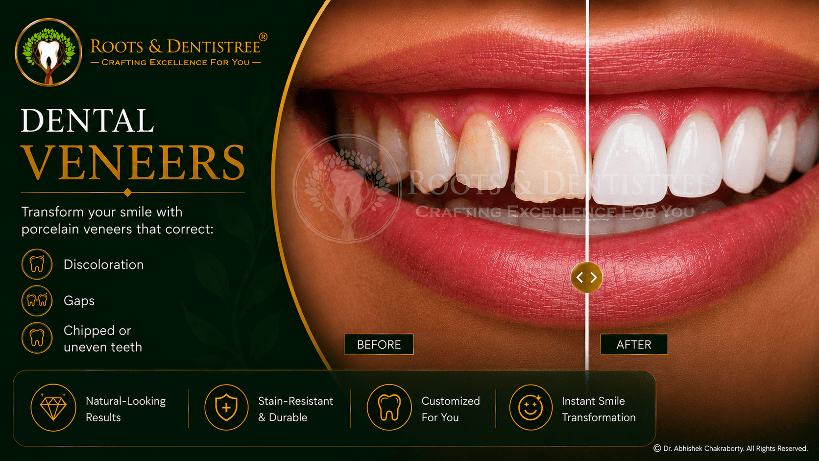 Dental porcelain veneers@ ROOTS & DENTISTREE