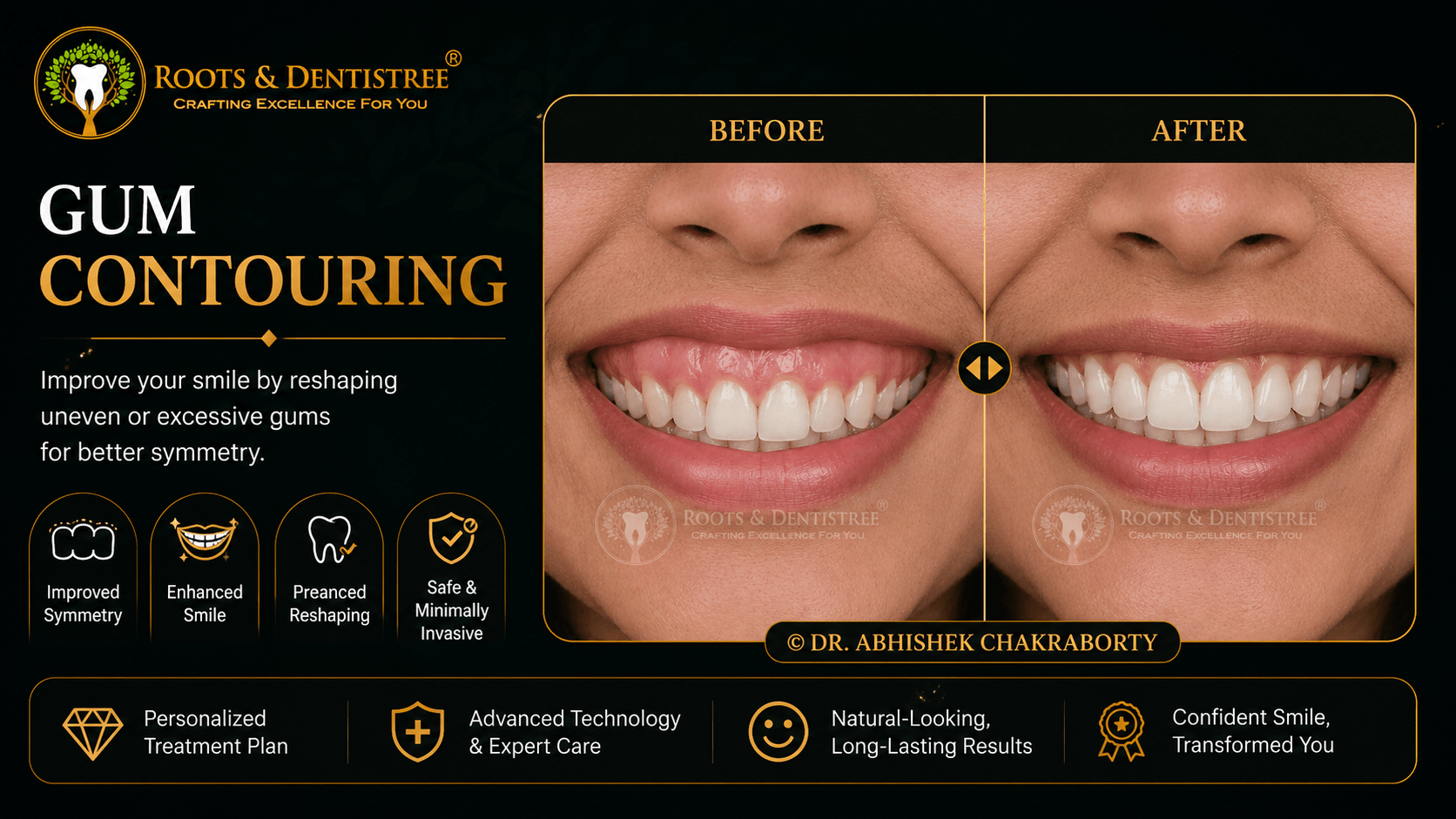 GUM CONTOURING @ ROOTS & DENTISTREE