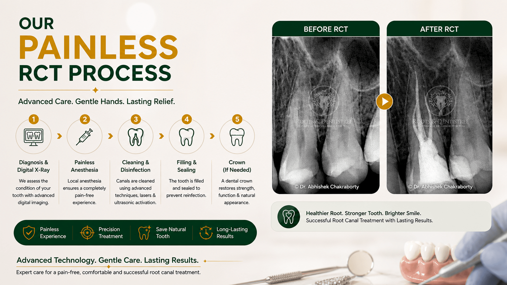 ROOT CANAL TREATMENT PROCESS @ ROOTS & DENTISTREE