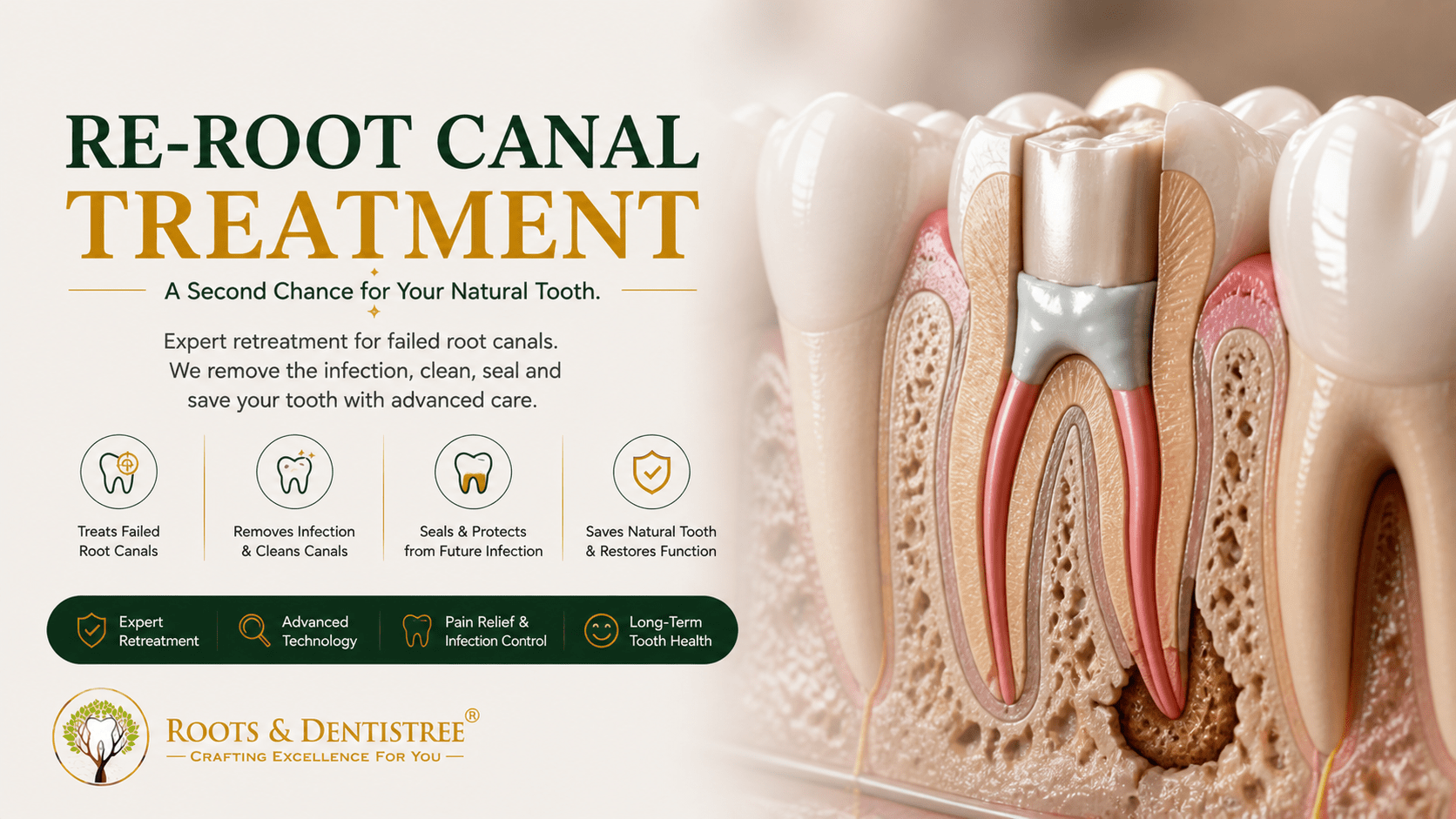 Re-RCT @ROOTS DENTISTREE