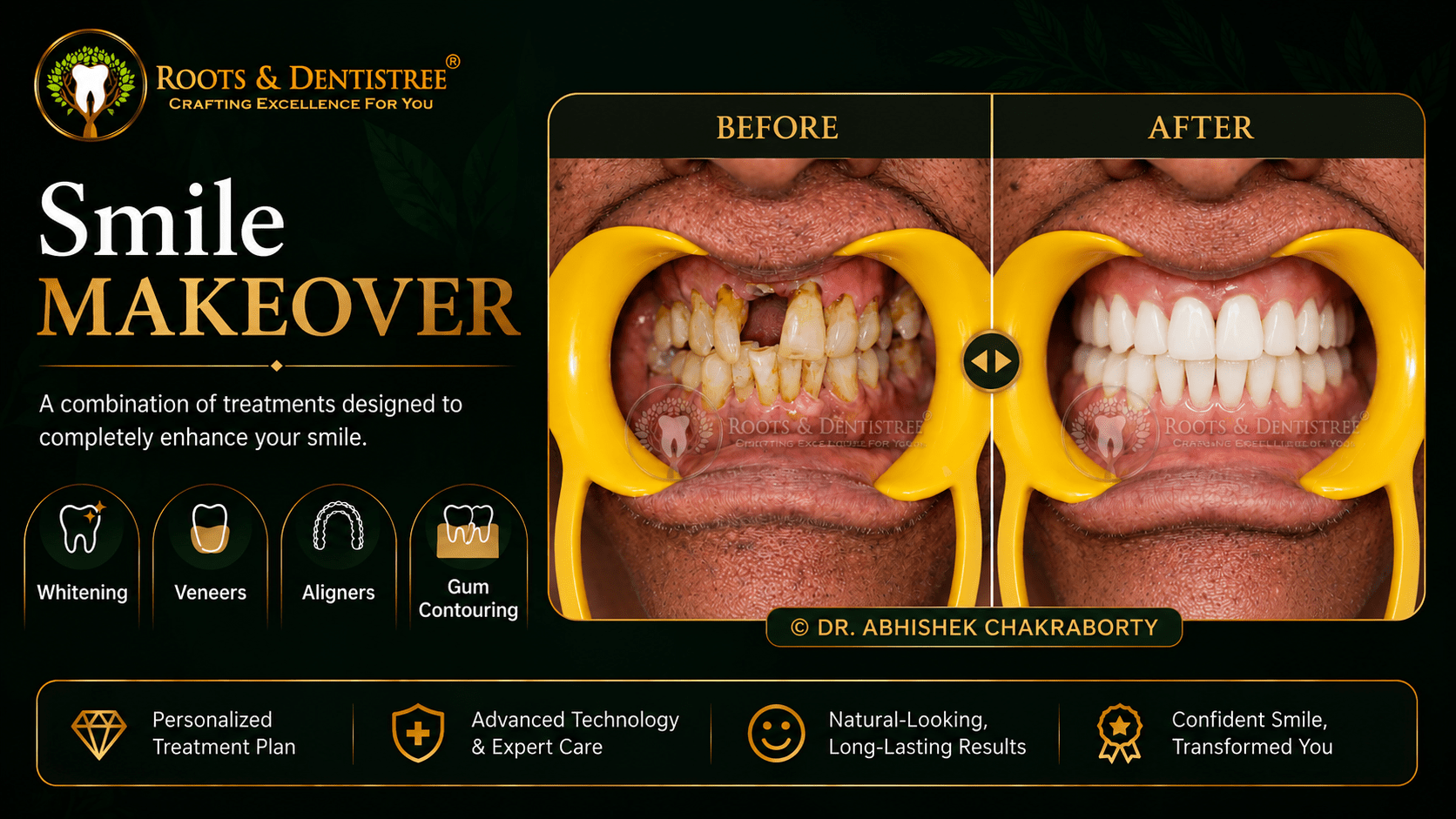 SMILE MAKEOVER @ ROOTS & DENTISTREE