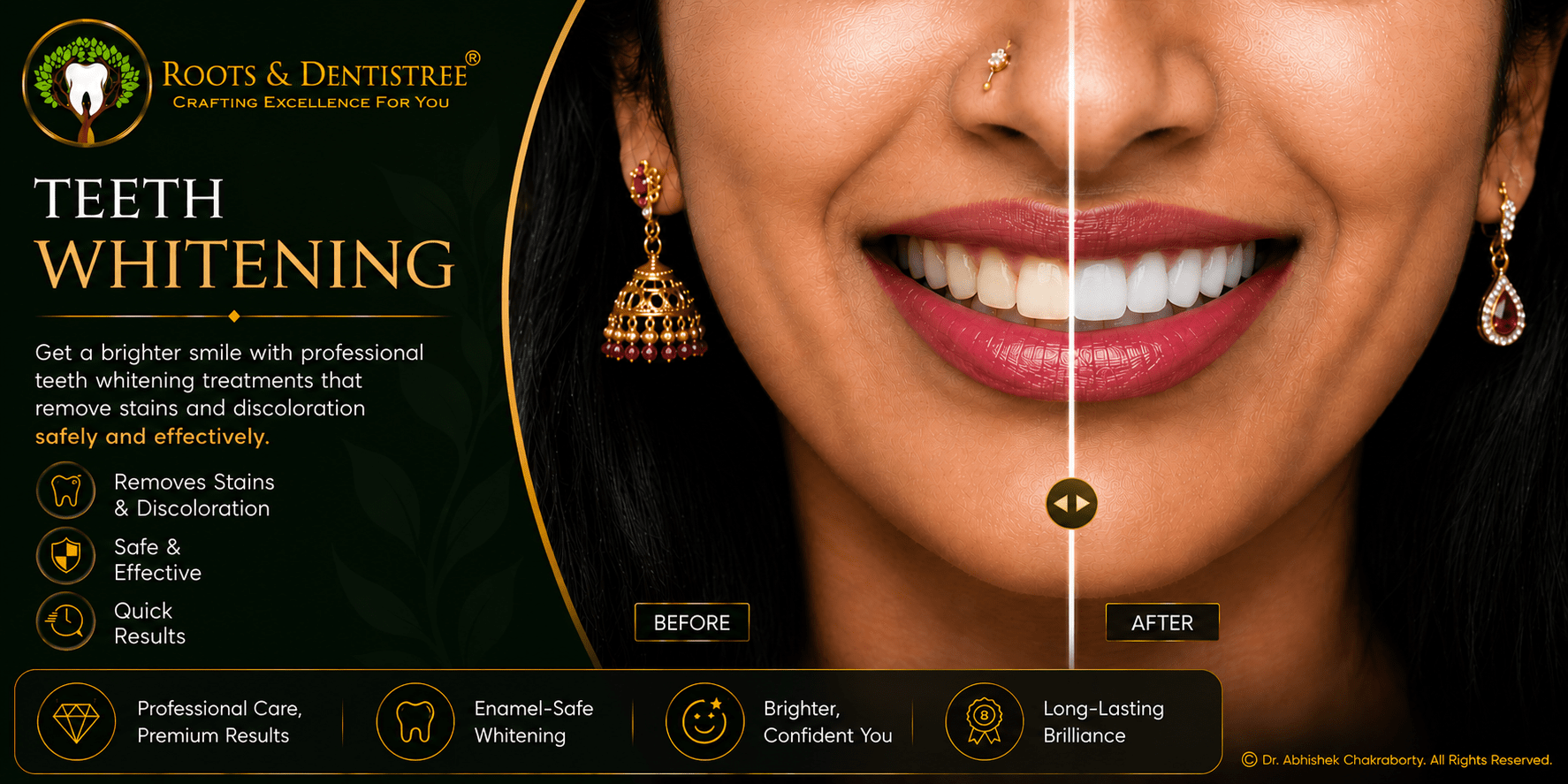 TEETH BLEACHING@ ROOTS & DENTISTREE