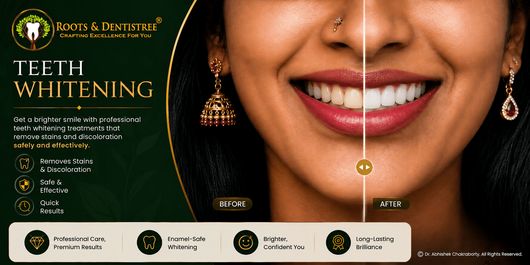 TEETH WHITENING@ ROOTS & DENTISTREE