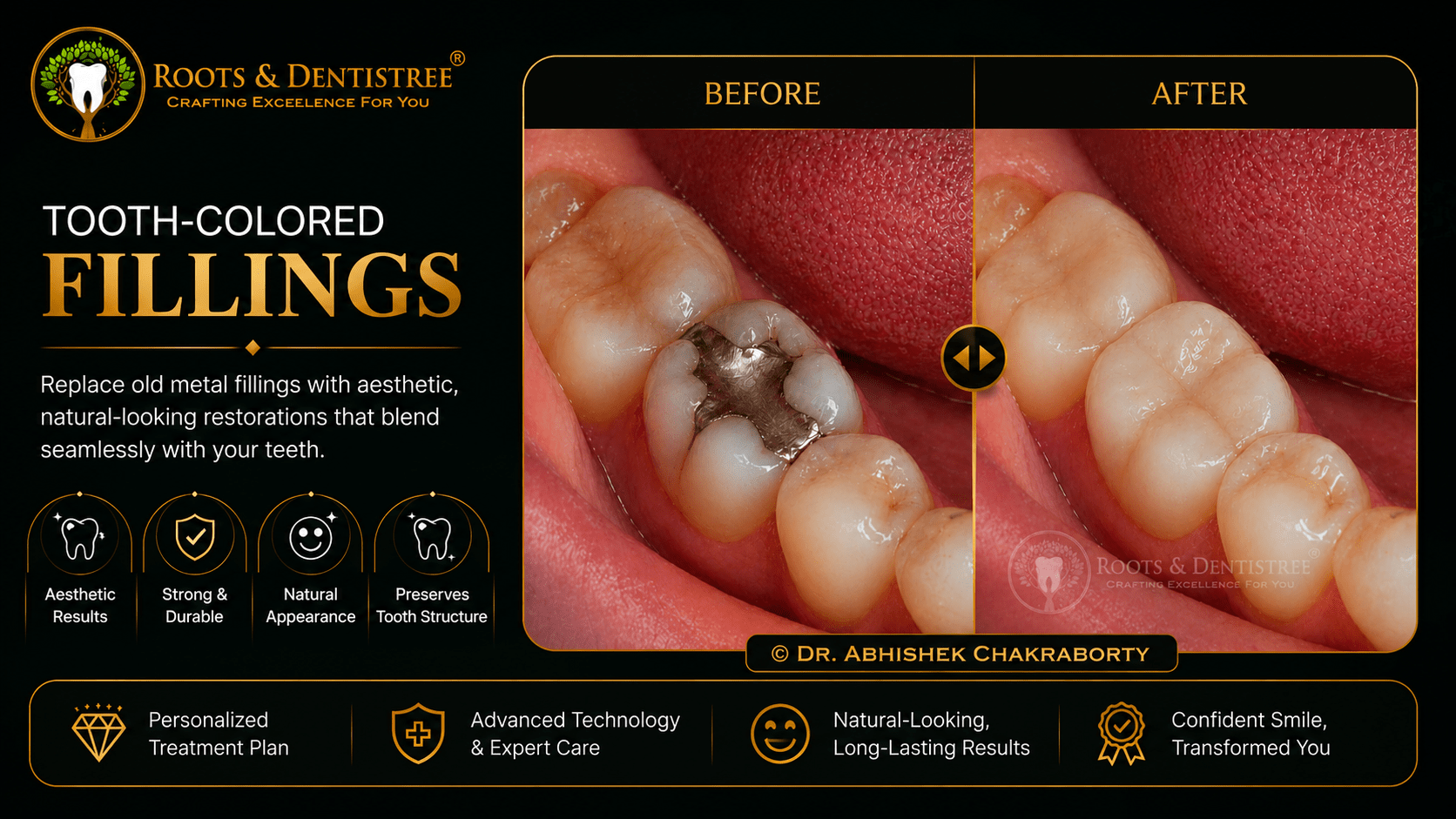 TOOTH COLORED FILLING @ ROOTS & DENTISTREE