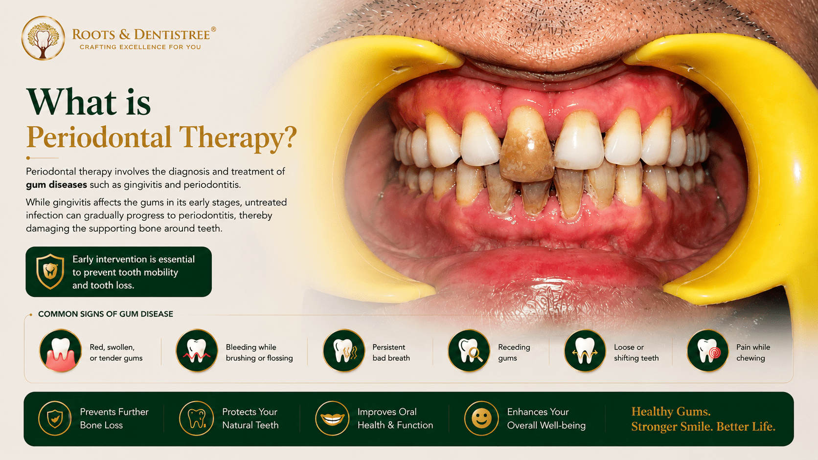 WHAT IS PERIODONTAL (GUM) THERAPY@ ROOTS & DENTISTREE