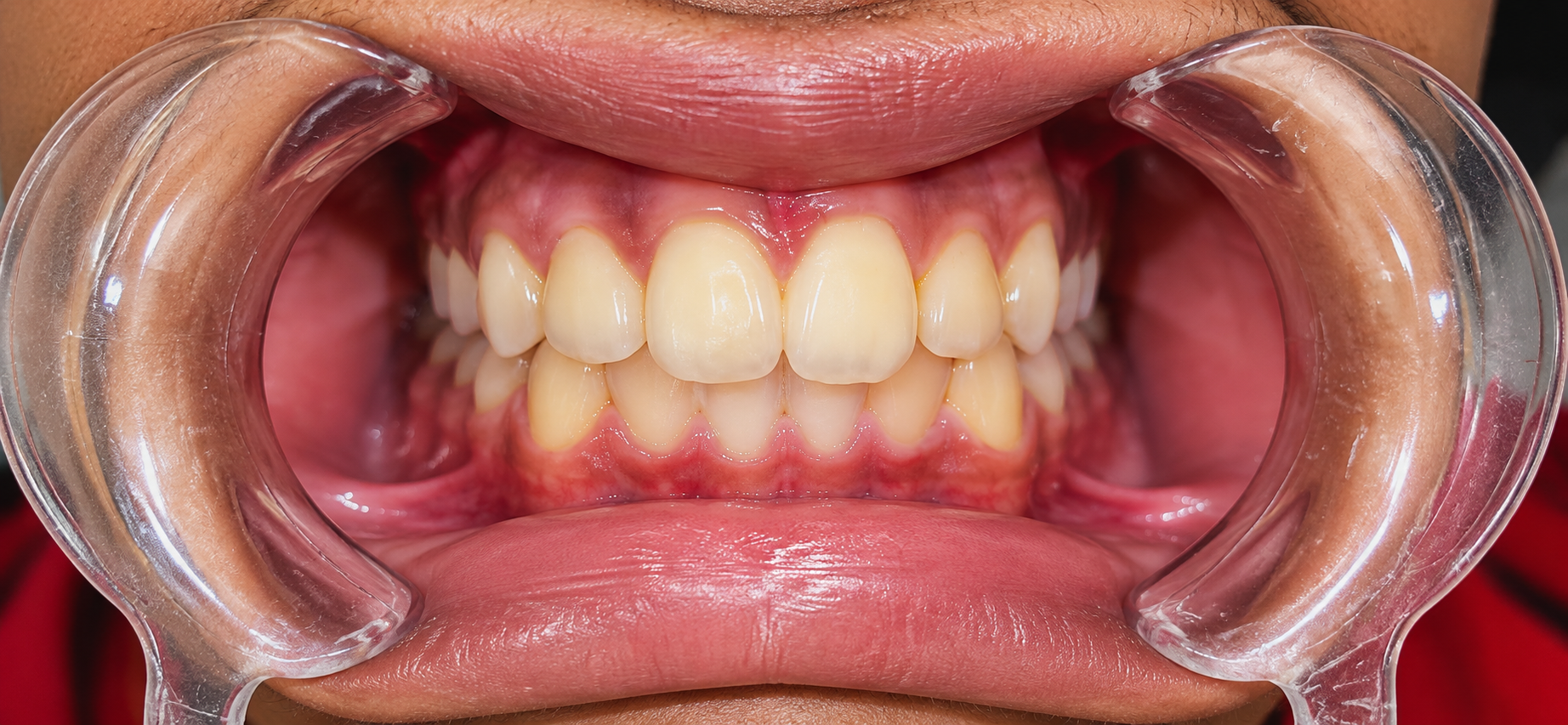 Close-up of upper and lower teeth with reddened gums, held open by clear dental cheek retractors for a clinical exam.