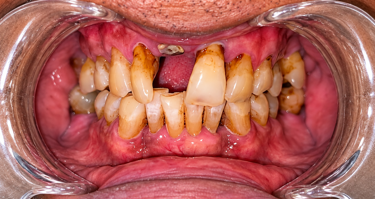 Close-up of a mouth with severe tooth crowding, staining, and a missing upper front tooth; inflamed gums are visible.
